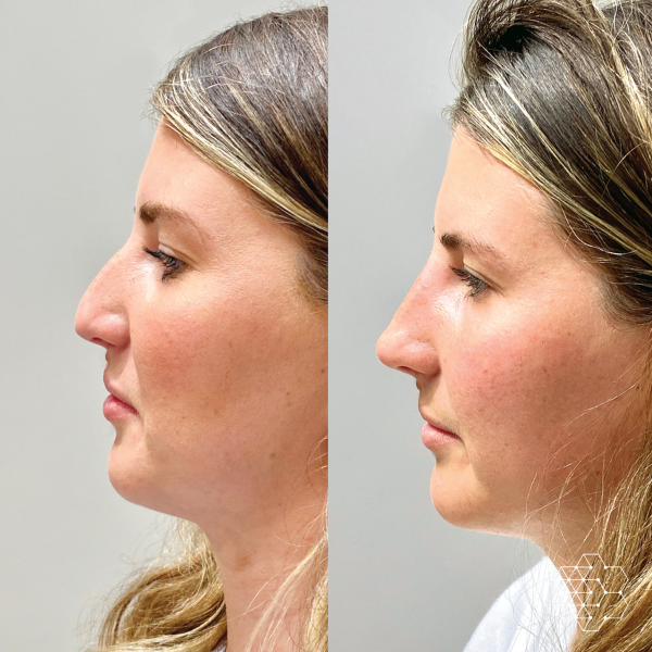 Non Surgical Nose Job
