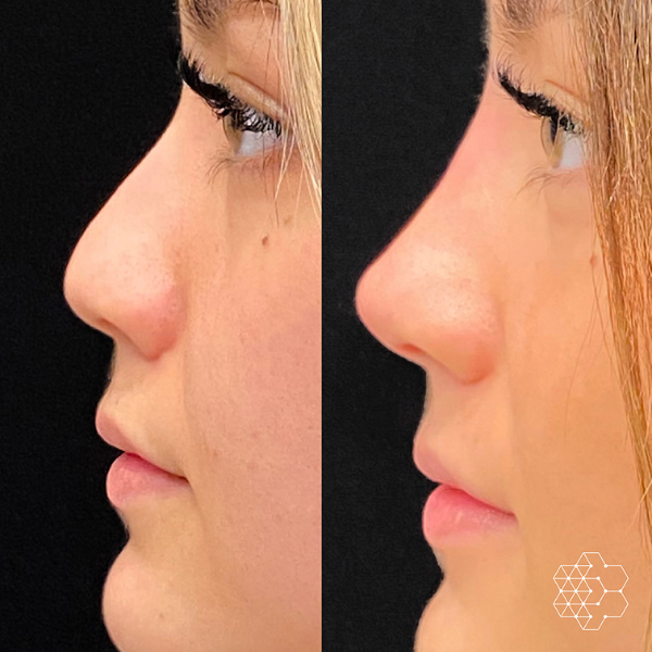 Non Surgical Nose Job