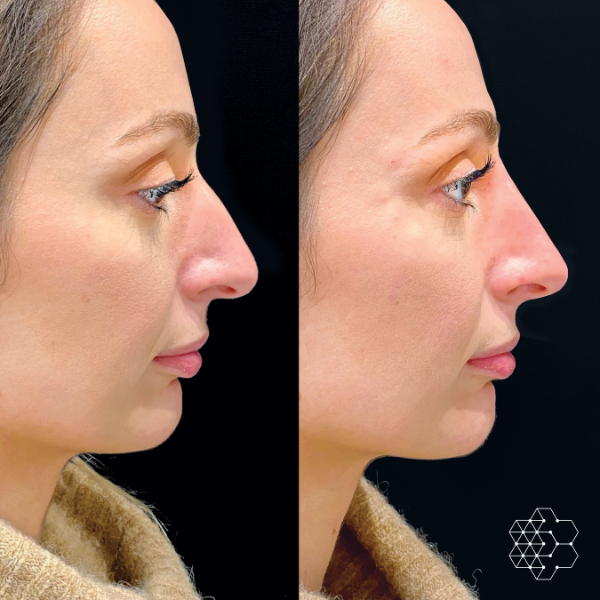 Non Surgical Nose Job