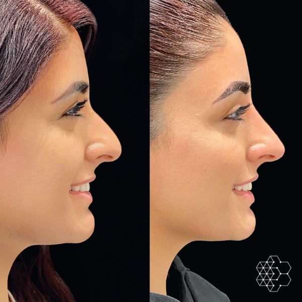 Non Surgical Nose Job