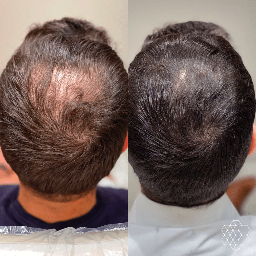 PRP Hair Restoration