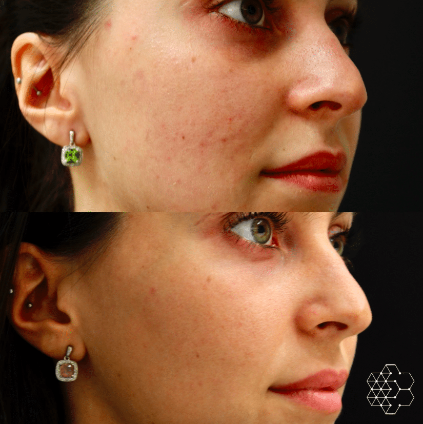 When Is the Best Season for BBL Treatment